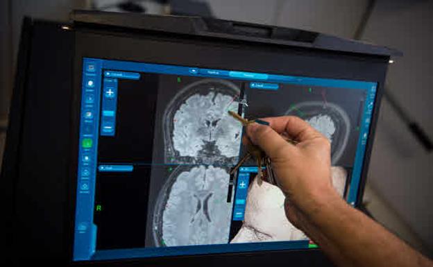 Operación de cerebro a paciente con epilepsia consciente en el hospital de Cruces./El Correo