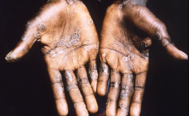 Lesions produced on the skin by monkeypox.