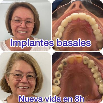 Basal implants: the possibility of having fixed teeth on the same day